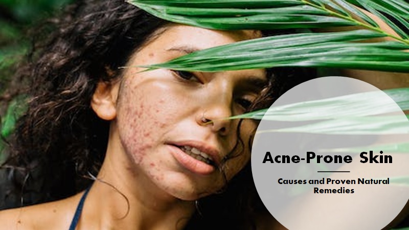 acne-prone skin